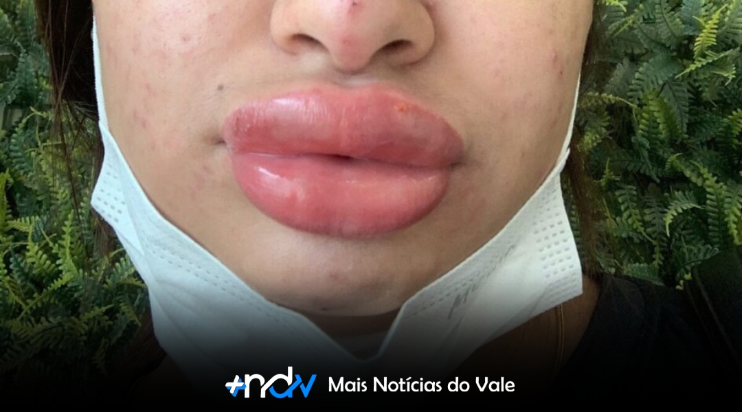 Mulheres denunciam falsa biomédica por procedimentos estéticos que causaram deformações e infecções em SC